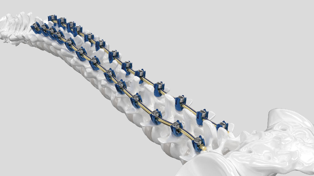 Ennovate® Thoracolumbar & Sacropelvic Chirurgiemodul