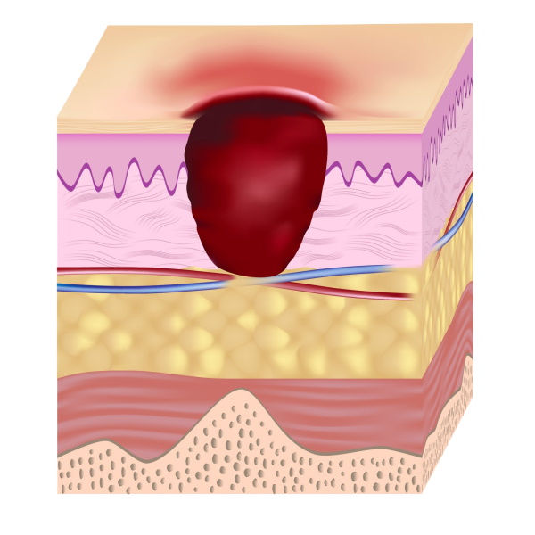 Abbildung:: Druckgeschwür im Stadium 3