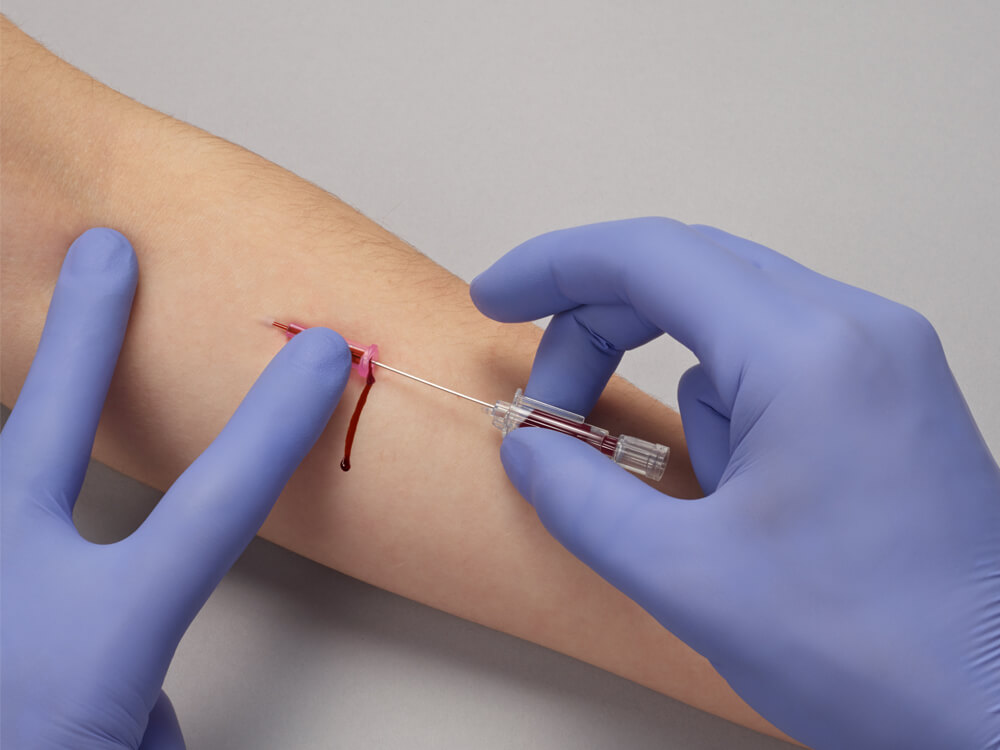 Die Hände einer medizinischen Fachkraft mit blauen Handschuhen entnehmen vorsichtig mit einer Spritze Blut aus dem Arm des Patienten