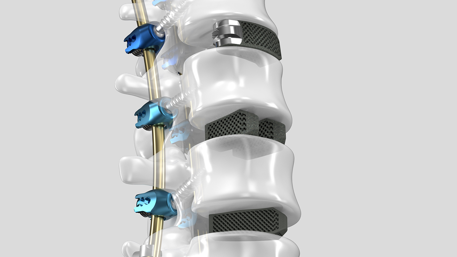 Wirbelkörperfusionsgeräte aus dem 3D-Drucker